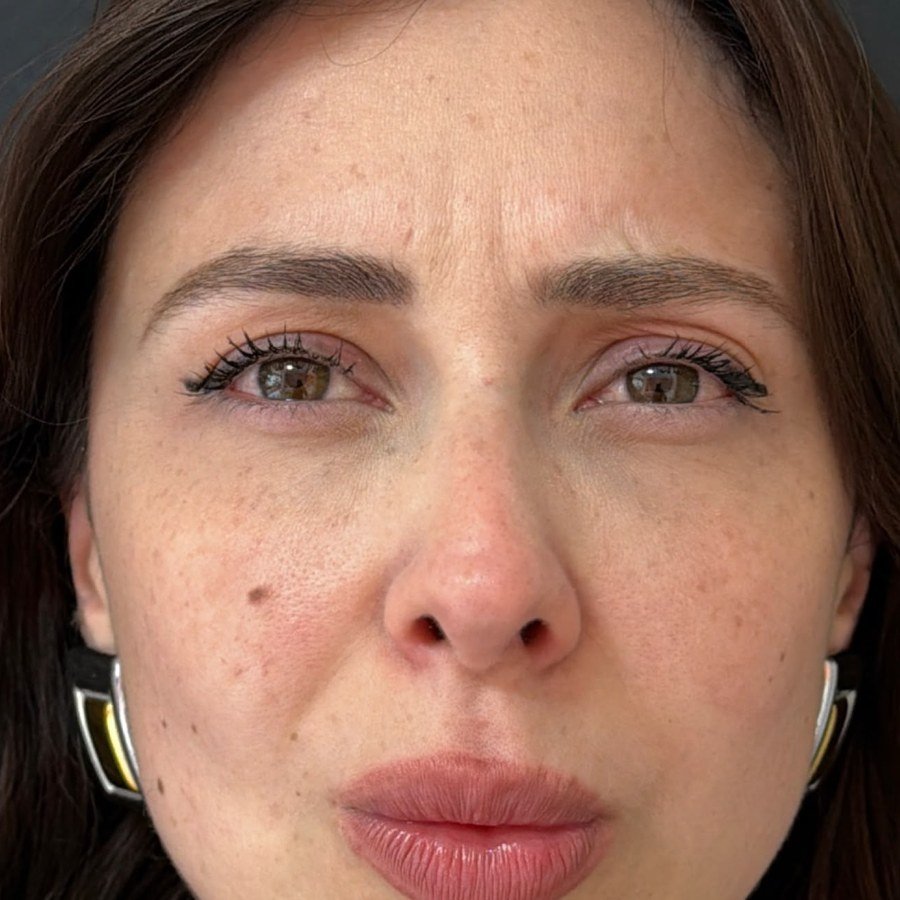 Depois — toxina botulínica