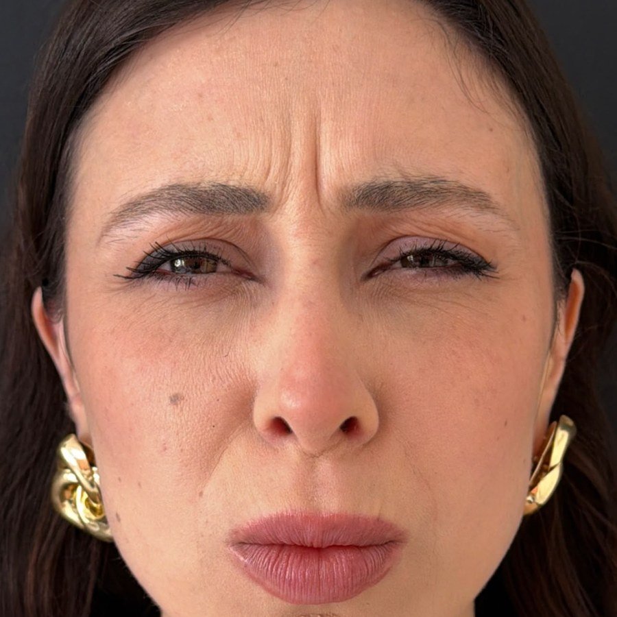 Antes — toxina botulínica