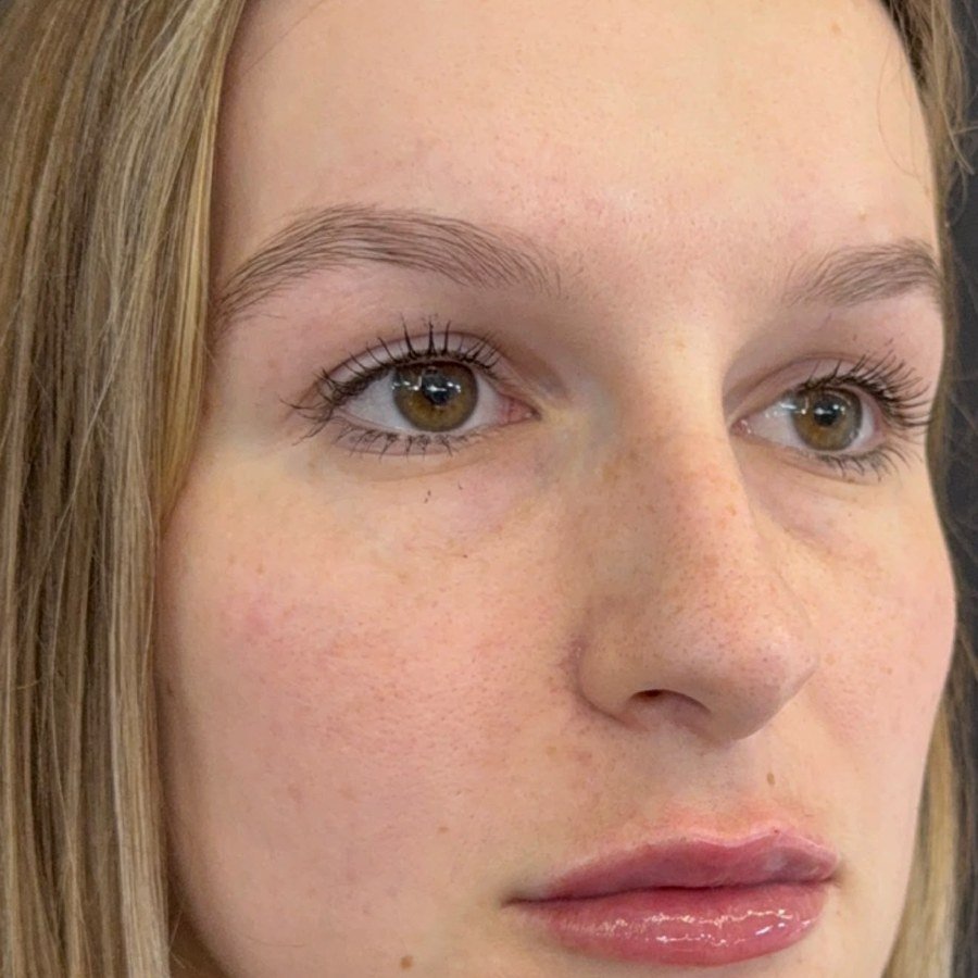 Depois — preenchimento labial