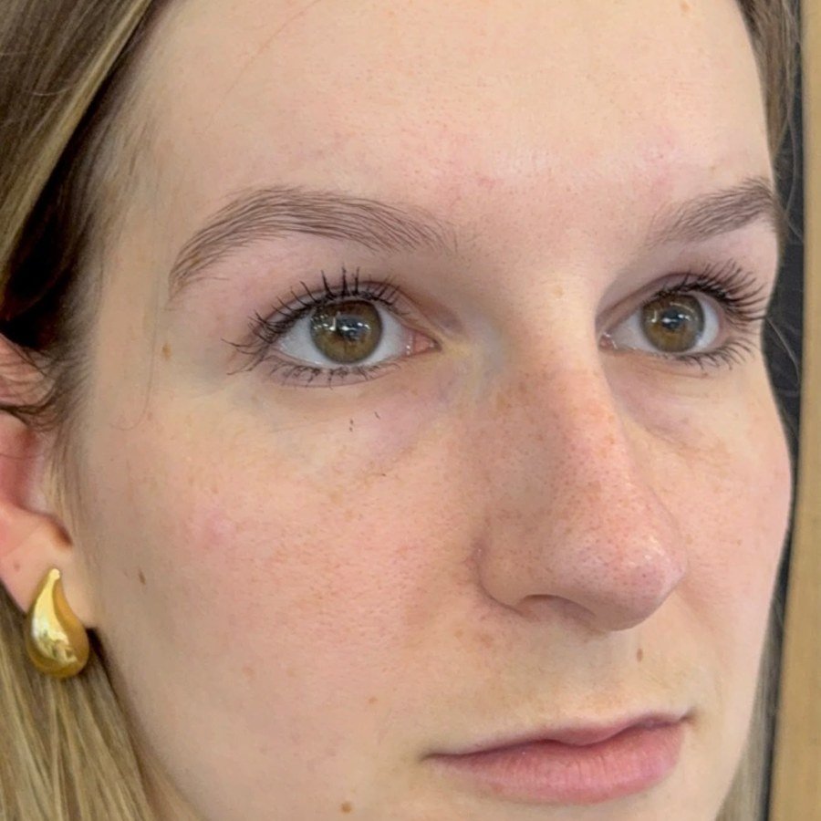 Antes — preenchimento labial